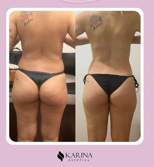 Antes e depois com a Lipoescultura Gessada
