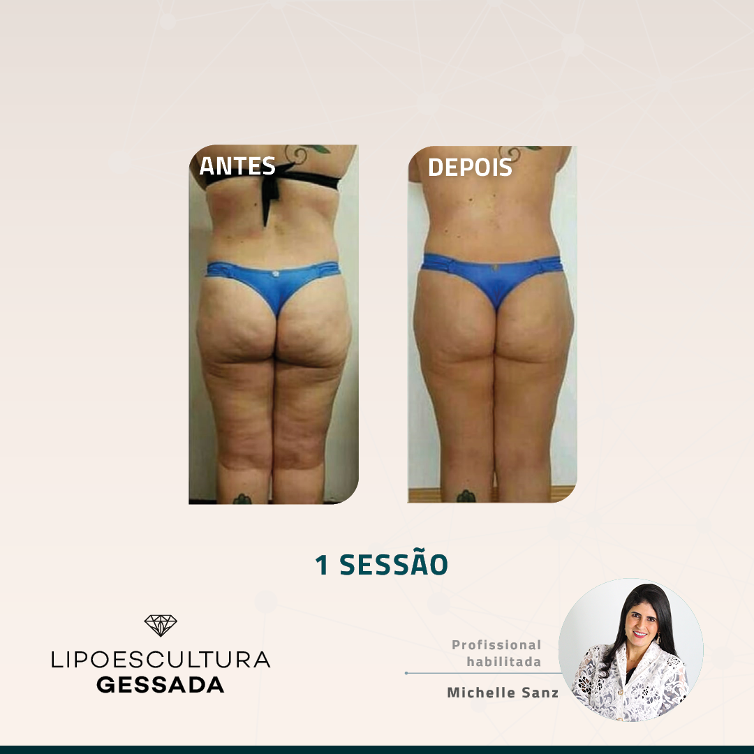 Antes e depois com a Lipoescultura Gessada