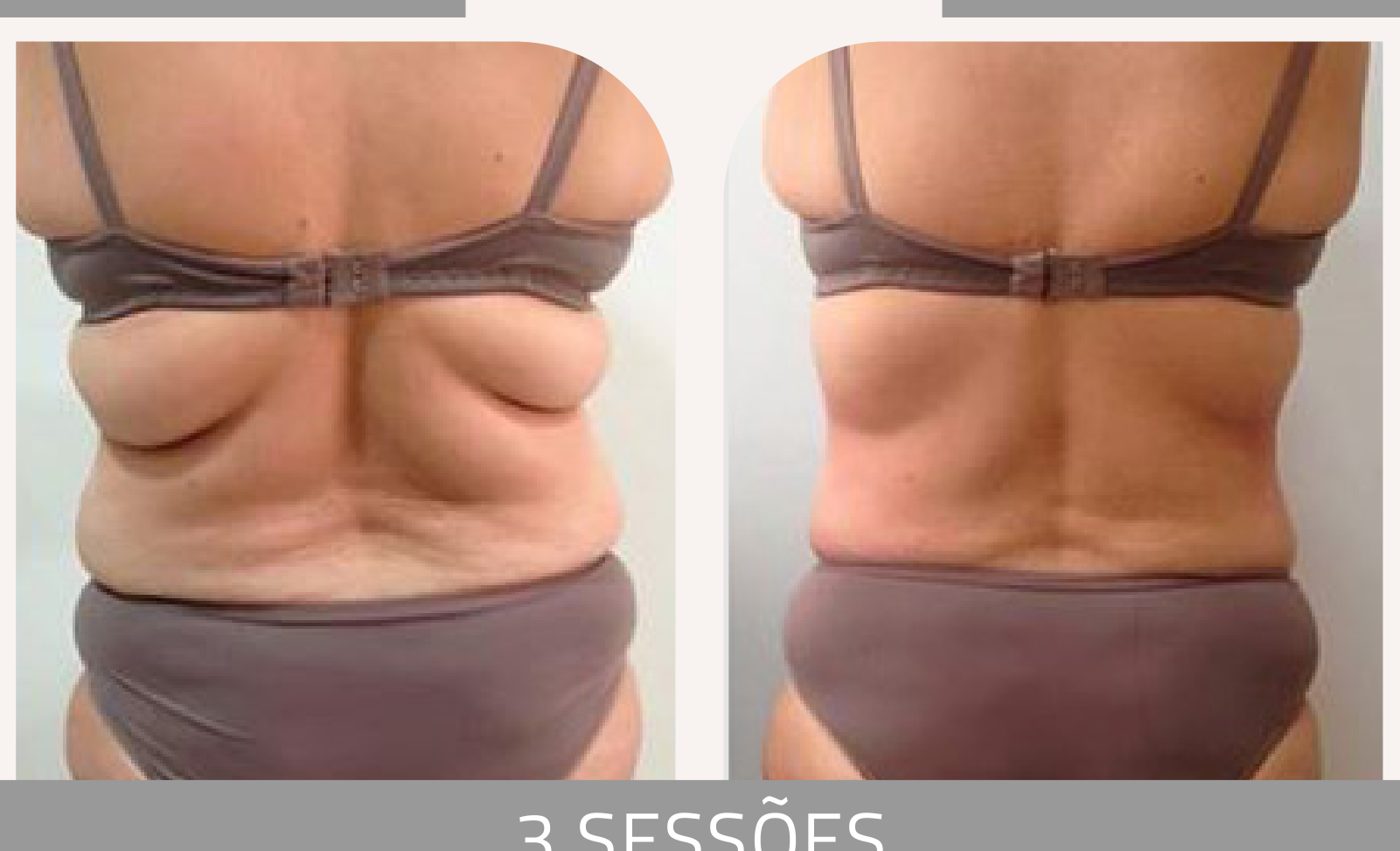 Antes e depois com a Lipoescultura Gessada — Apresentação Oficial Bothanica Mineral
