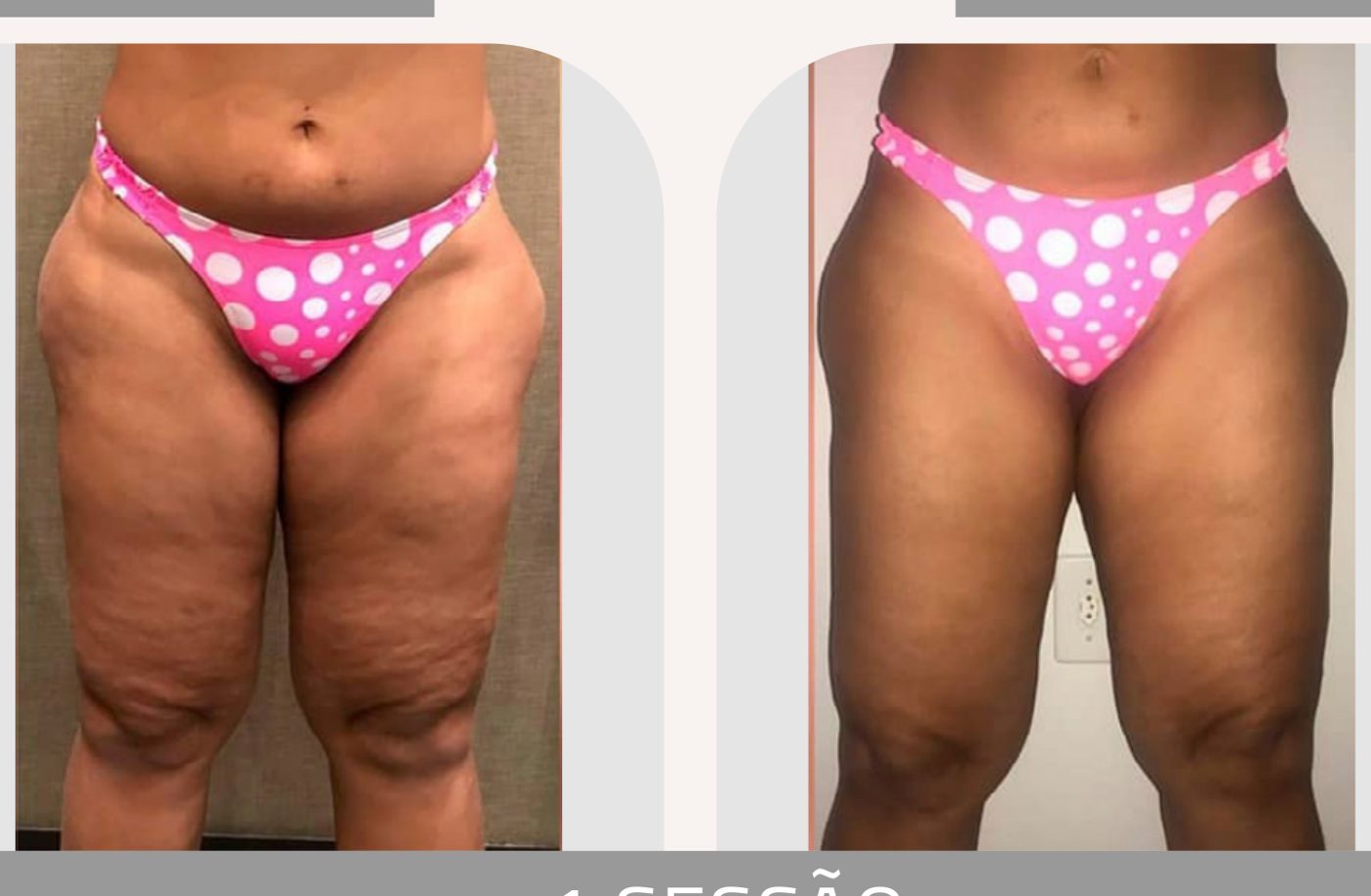 Antes e depois com a Lipoescultura Gessada — Apresentação Oficial Bothanica Mineral