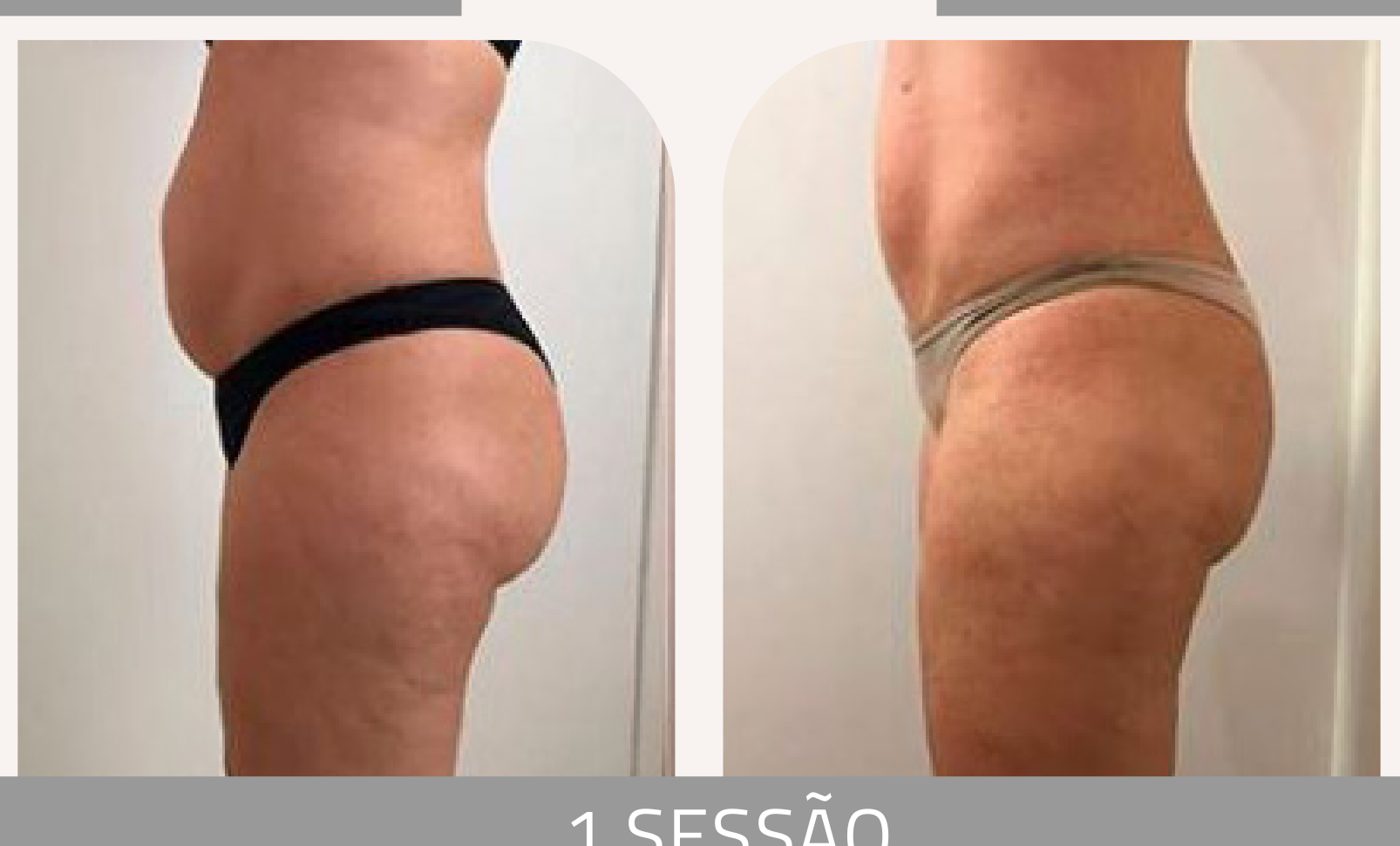 Antes e depois com a Lipoescultura Gessada — Apresentação Oficial Bothanica Mineral
