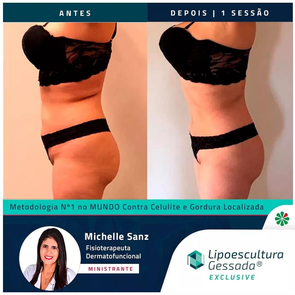 Antes e depois com a Lipoescultura Gessada — resultado de 1 sessão