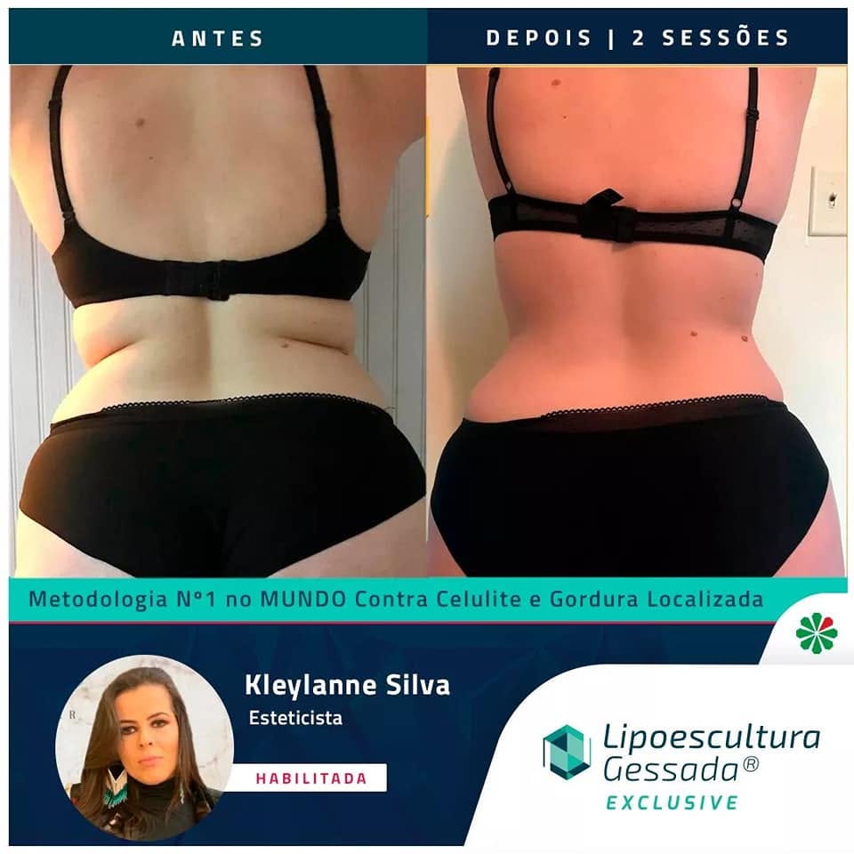 Antes e depois com a Lipoescultura Gessada — resultado de 2 sessões
