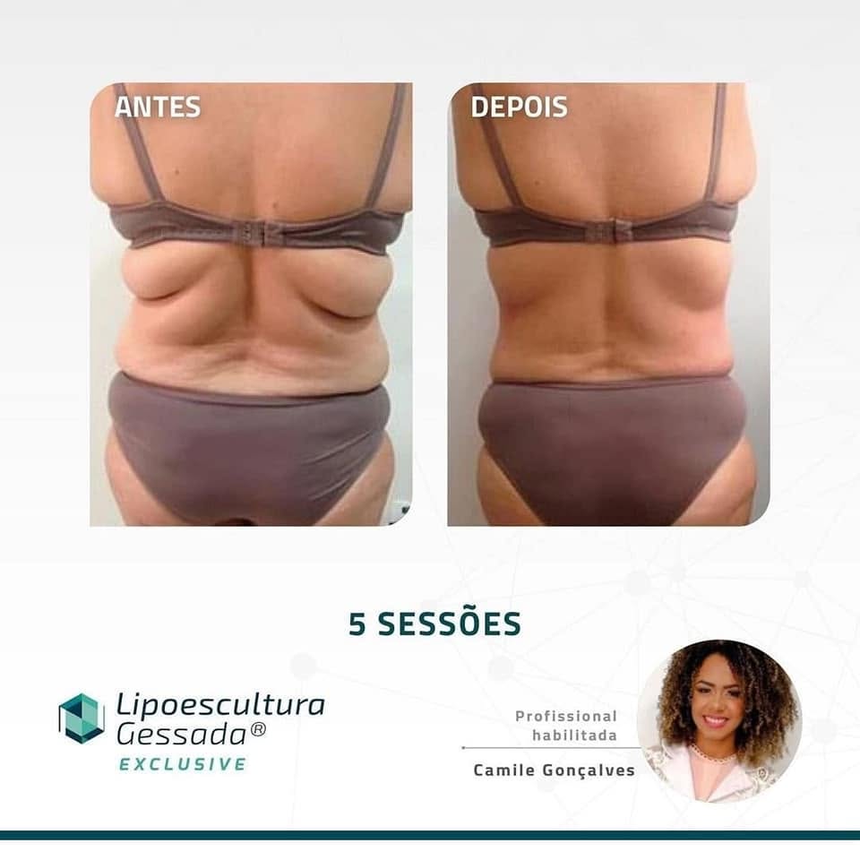 Antes e depois com a Lipoescultura Gessada — resultado de 5 sessões