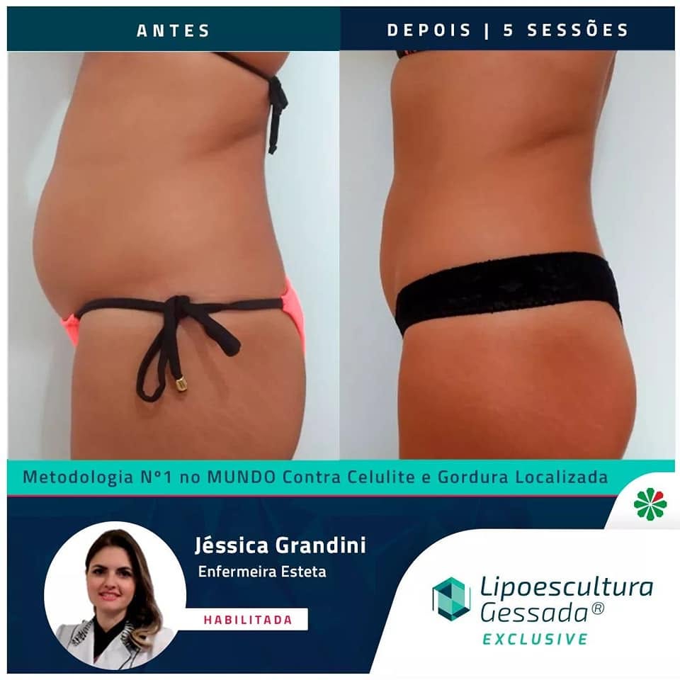Antes e depois com a Lipoescultura Gessada — resultado de 5 sessões