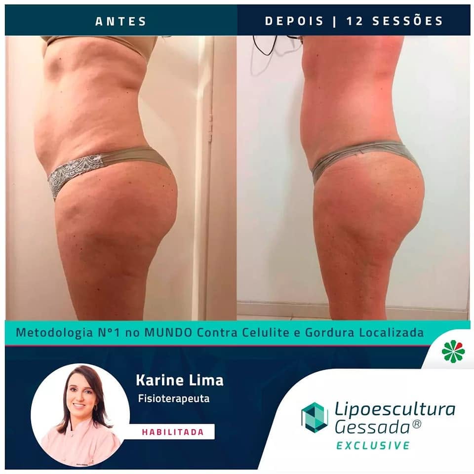 Antes e depois com a Lipoescultura Gessada — resultado de 12 sessões