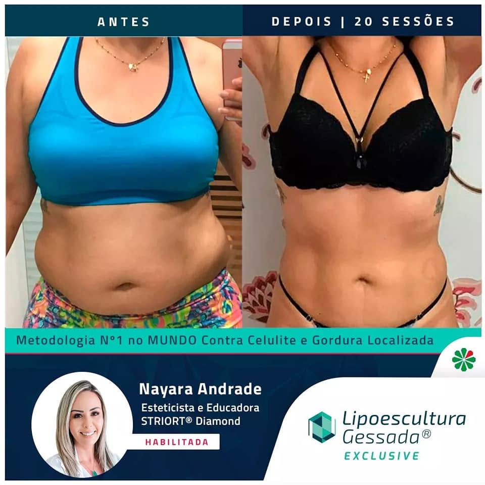 Antes e depois com a Lipoescultura Gessada — resultado de 20 sessões