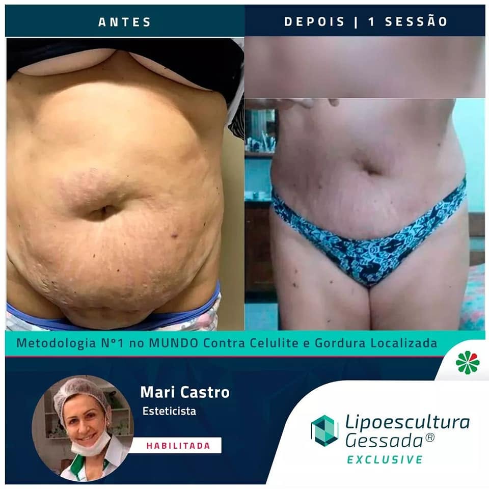 Antes e depois com a Lipoescultura Gessada — flacidez pós-parto, 1 sessão