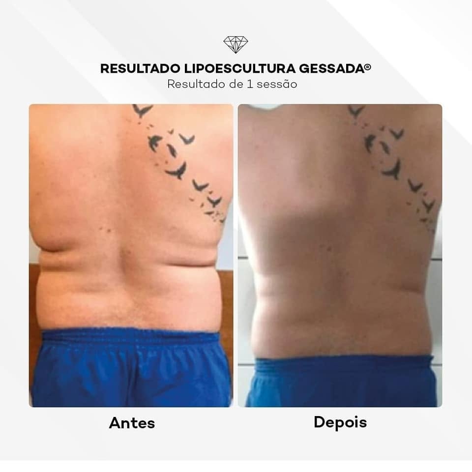 Antes e depois com a Lipoescultura Gessada — paciente masculino, 1 sessão